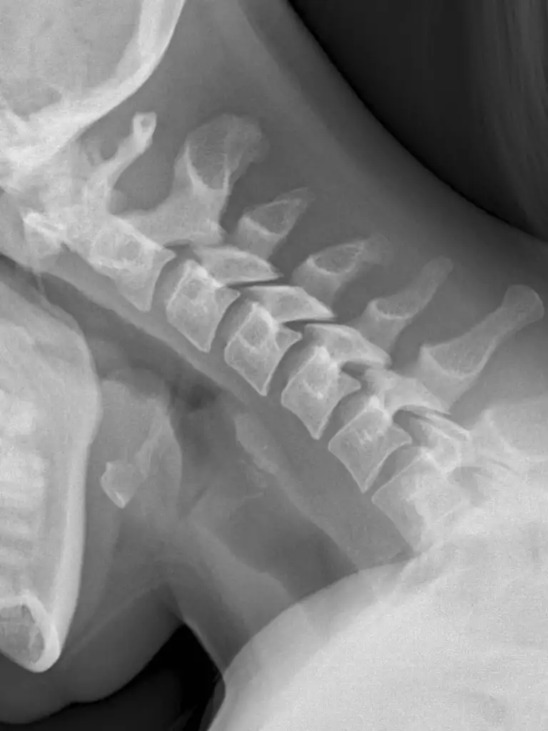 x-ray cervical spine flexion view